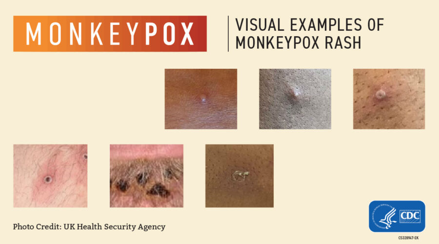Monkeypox-Visuals